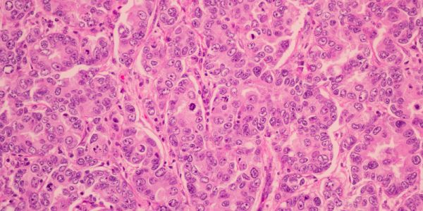 A pathology slide of cancer cells